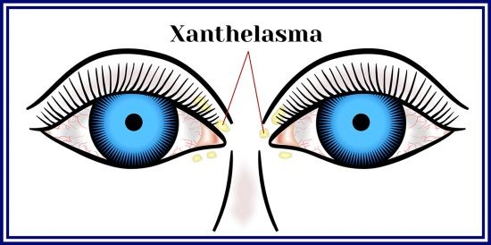 210906142144-xanthelasma-550x274.jpg
