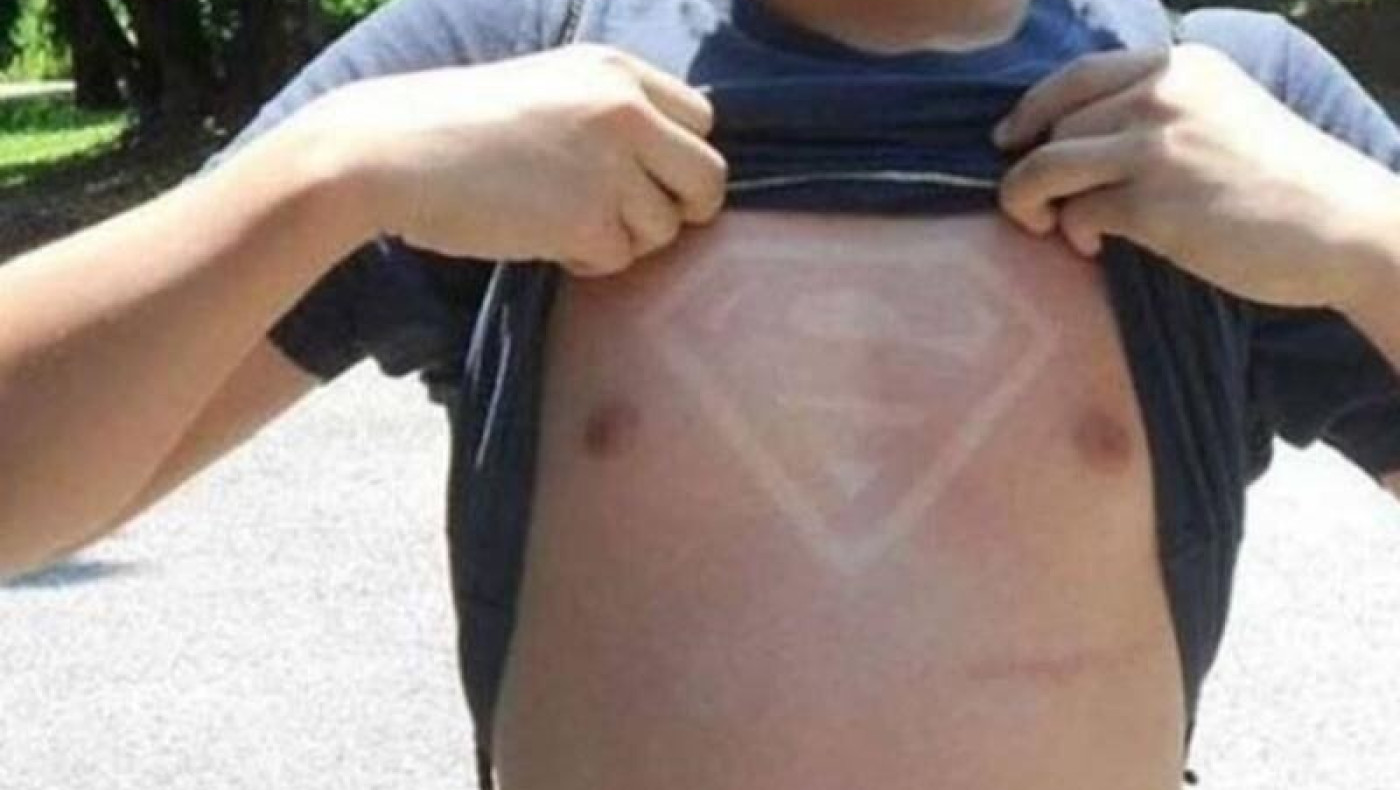 Καίγονται από τον ήλιο για να κάνουν εγκαύματα με σχέδια