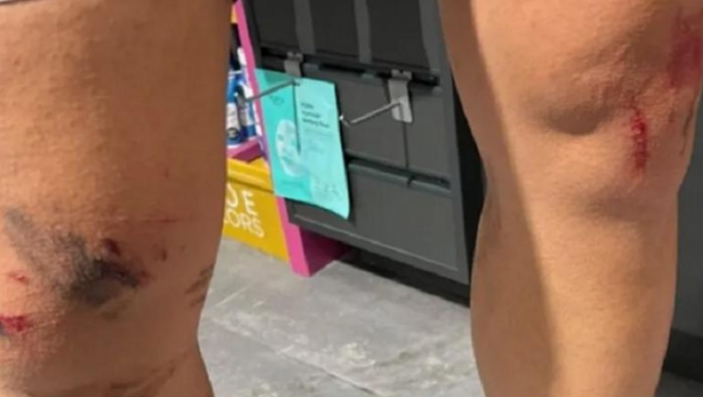 Κρυονέρι: Καταγγελία άνδρα ότι δέχθηκε επίθεση από λύκο – «Πάλευα μαζί του για οκτώ λεπτά»