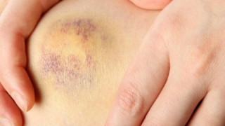 Πως θα απαλλαγείτε γρηγορότερα από τις μελανιές