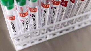 Ευλογιά πιθήκων – Παγώνη: «Παιδιά και έγκυες κινδυνεύουν περισσότερο»