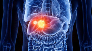 Ο «αόρατος» εχθρός του ήπατος-Οι επιπτώσεις για την υγεία μας